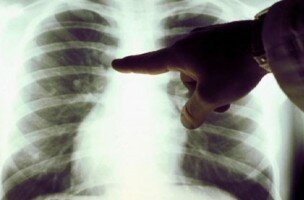 Рентген — польза и вред