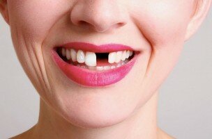 Отсутствие зубов вредит здоровью и изменяет лицо